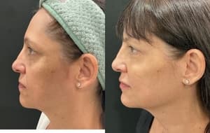 Dermal Filler before and after 3