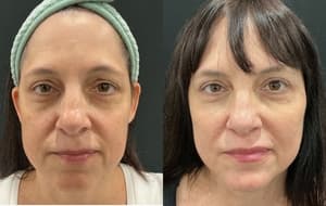 Dermal Filler before and after 4
