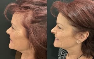 Neuromodulators (Tox) before and after 1