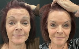 Neuromodulators (Tox) before and after 3