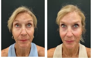 Neuromodulators (Tox) before and after 4