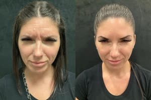 Neuromodulators (Tox) before and after 5
