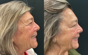 Neuromodulators (Tox) before and after 6
