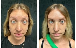 Neuromodulators (Tox) before and after 8