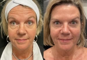 Neuromodulators (Tox) before and after 9
