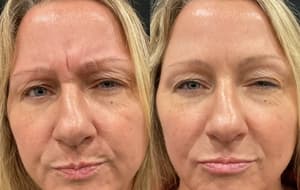 Neuromodulators (Tox) before and after 10