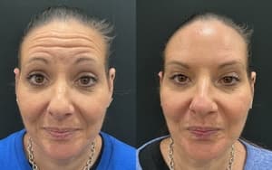Neuromodulators (Tox) before and after 11