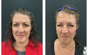 Neuromodulators (Tox) before and after 14
