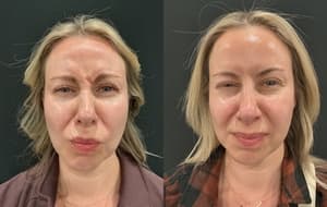 Neuromodulators (Tox) before and after 15