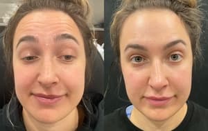 Neuromodulators (Tox) before and after 16