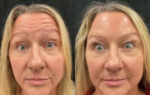 Neuromodulators (Tox) before and after 17