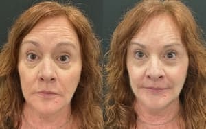 Neuromodulators (Tox) before and after 18