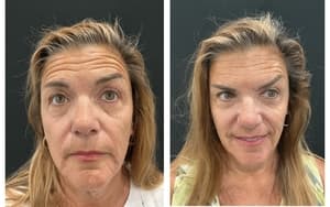 Neuromodulators (Tox) before and after 19