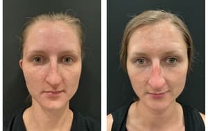 PhotoFacial: IPL For Face before and after 1