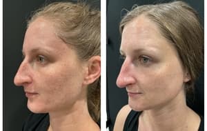 PhotoFacial: IPL For Face before and after 2