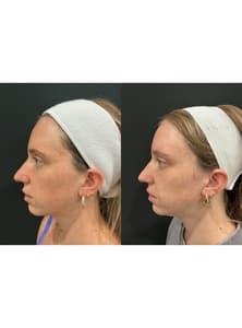 PhotoFacial: IPL For Face before and after 3