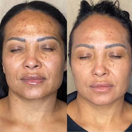 PhotoFacial: IPL For Face before and after 4