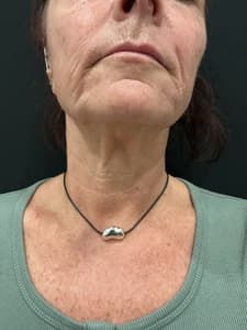 RF Microneedling before and after 2