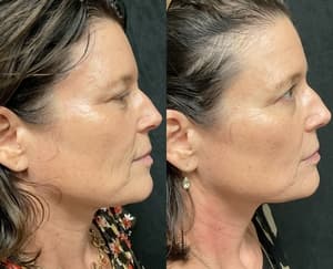 RF Microneedling before and after 3