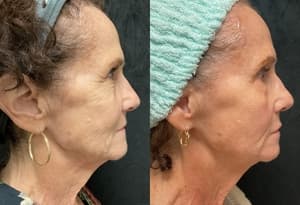 RF Microneedling before and after 4