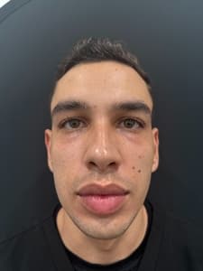 RF Microneedling before and after 5