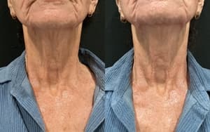 RF Microneedling before and after 6