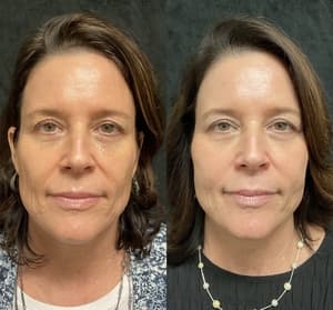 RF Microneedling before and after 7