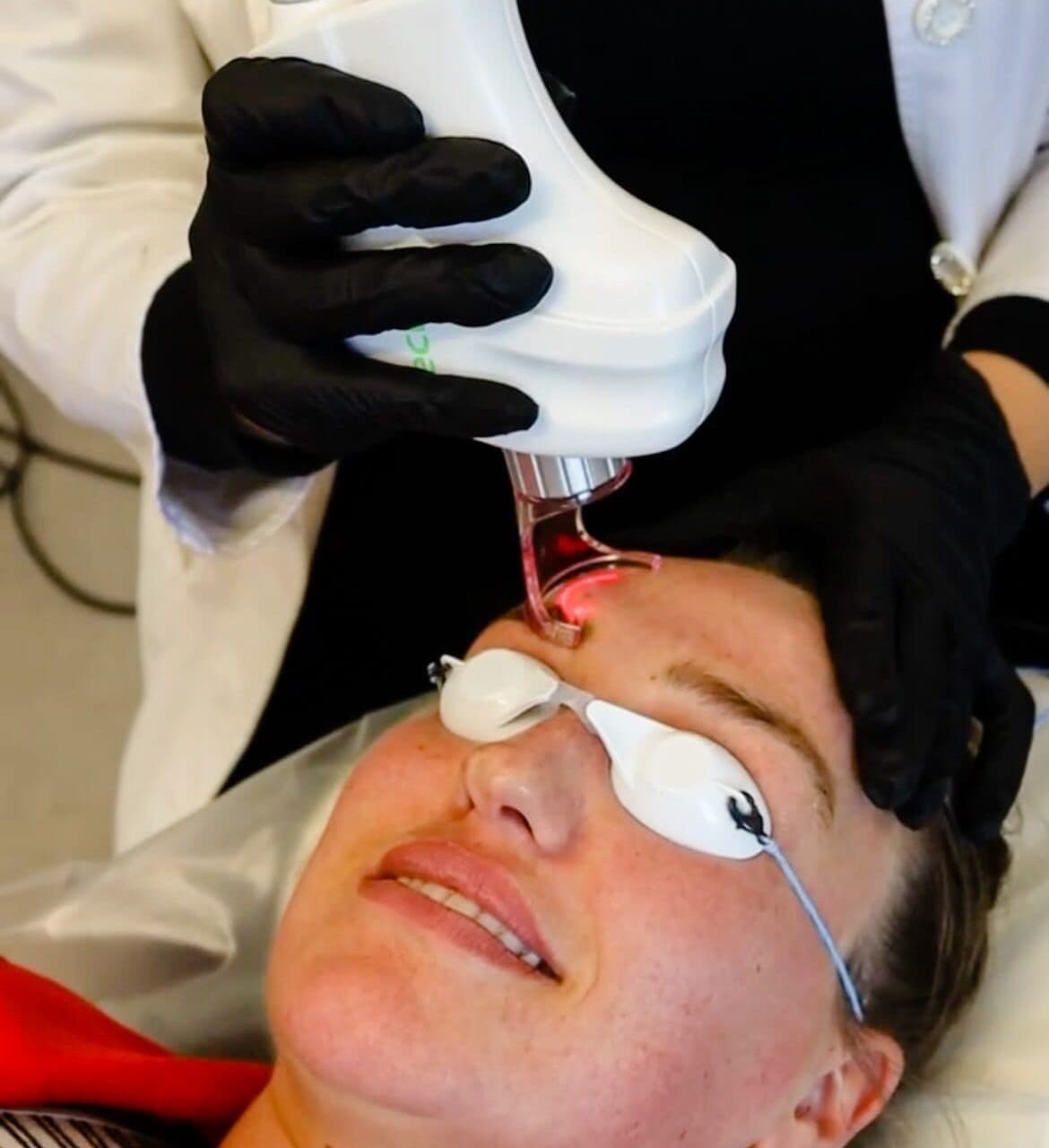 Fractional CO2 laser treatment for post-summer skin recovery