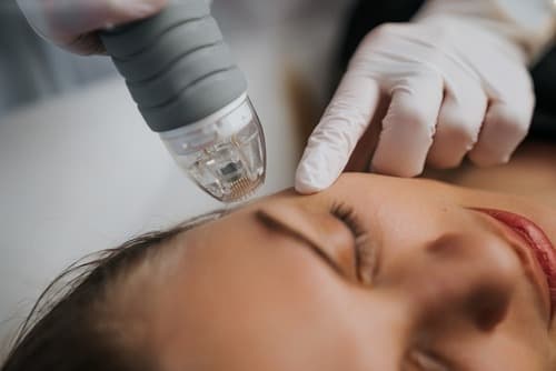 RF microneedling treatment in progress
